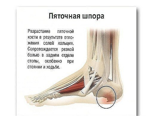 Пяточная шпора: 17 эффективных рецептов народной медицины